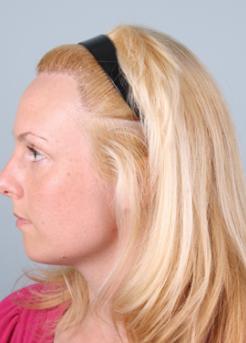After Hair Transplant&nbsp;Hairline